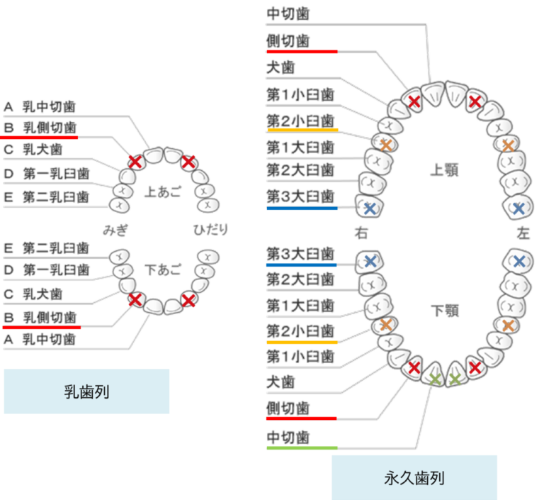歯が足りない～先天性欠如歯 | 船橋市東船橋の歯医者「ビバ歯科･矯正小児歯科」