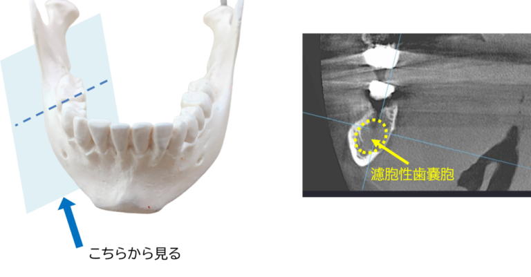 濾胞性嚢胞とは何ですか?