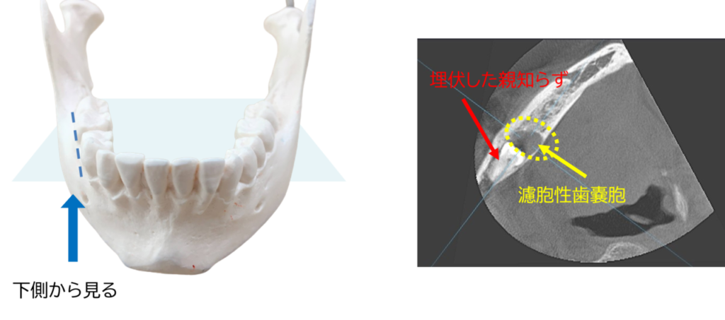 濾胞性嚢胞はどのように診断されますか?