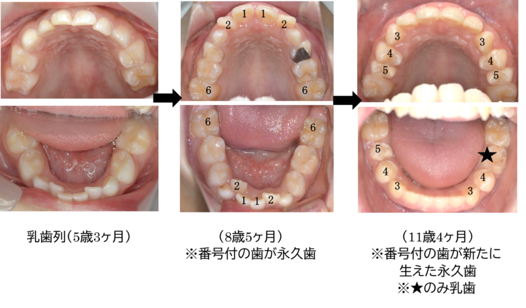 なんで歯って生えかわるの？ | 船橋市東船橋の歯医者「ビバ歯科･矯正小児歯科」