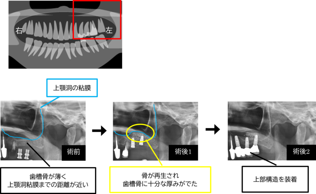 インプラント埋入前の準備~上顎洞底挙上手術 | 船橋市東船橋の歯医者「ビバ歯科・矯正小児歯科」